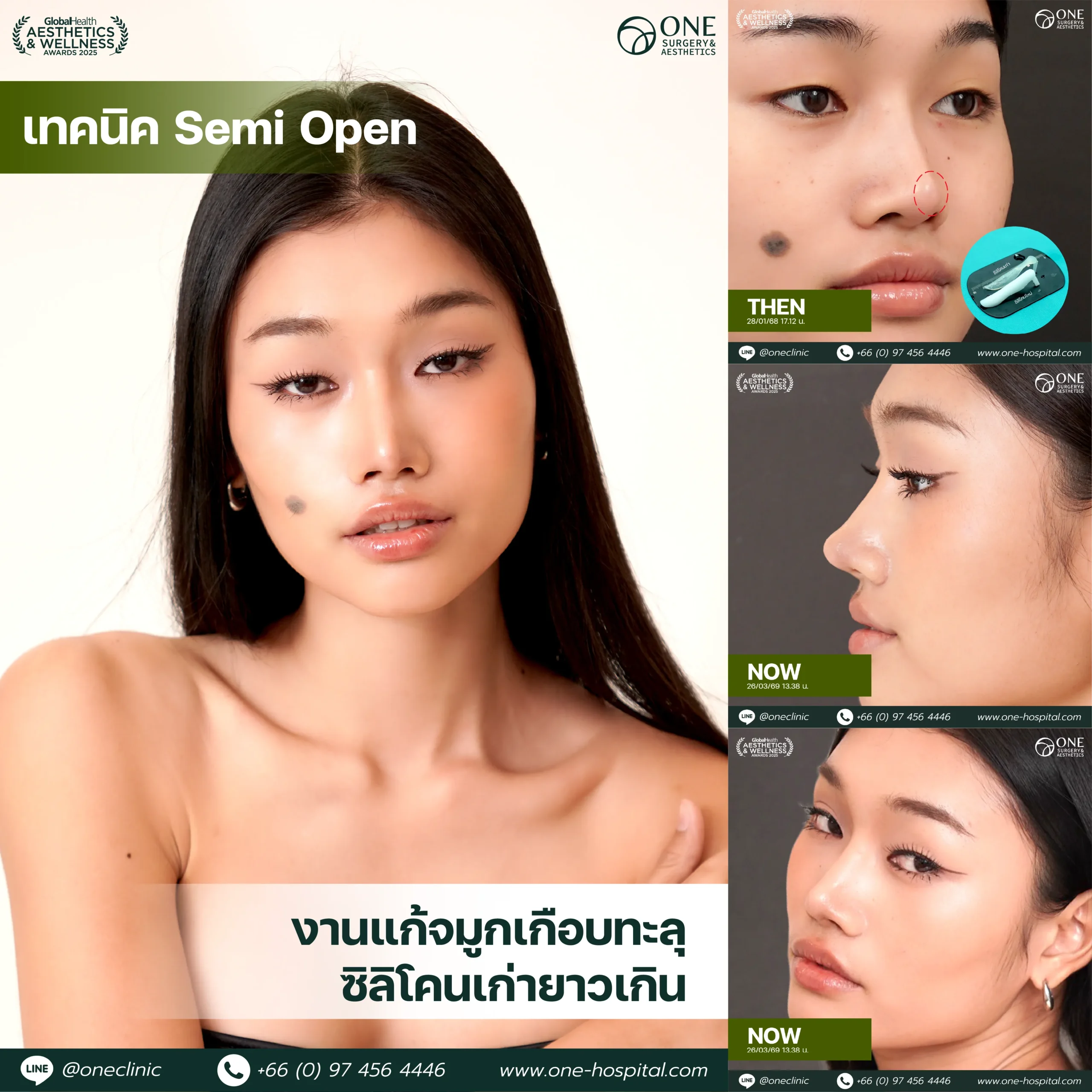 รวมรีวิว-เสริมจมูก-Web-รวมหน้า-02-1_2-scaled.webp